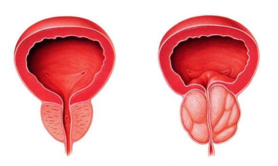 Normalna i upaljena prostata (prostatitis)