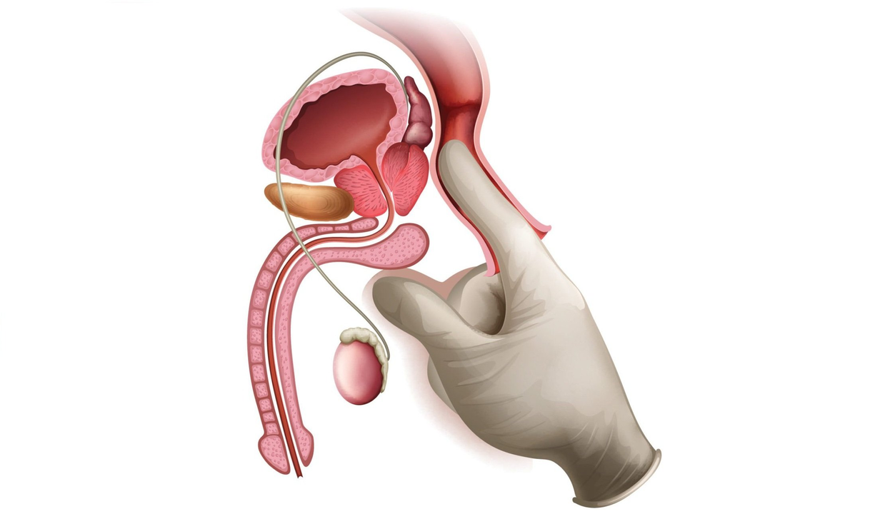 Masaža prostate