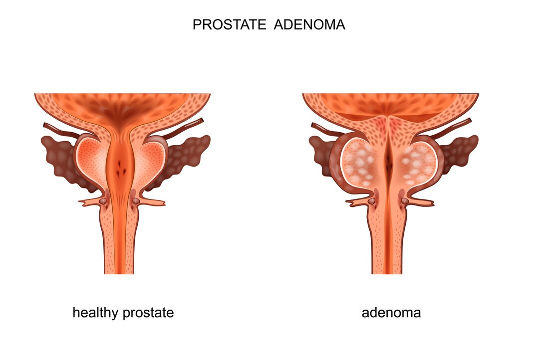 Zdrava prostata i adenom