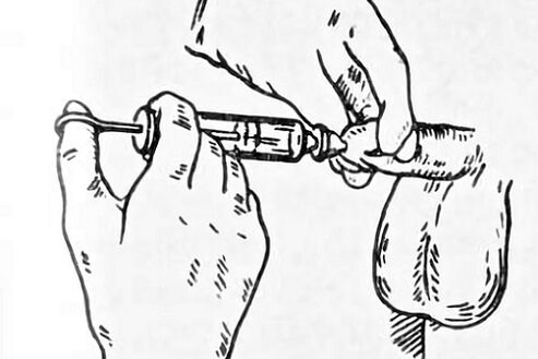 instilacije za prostatitis