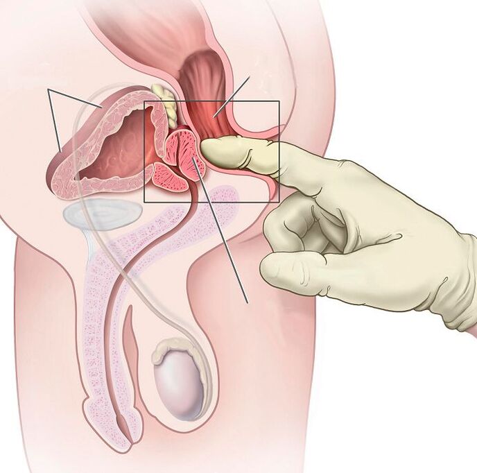 Masaža prostate za liječenje prostatitisa