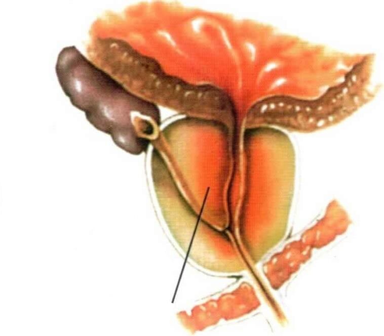 Upala tkiva prostate kod kroničnog prostatitisa